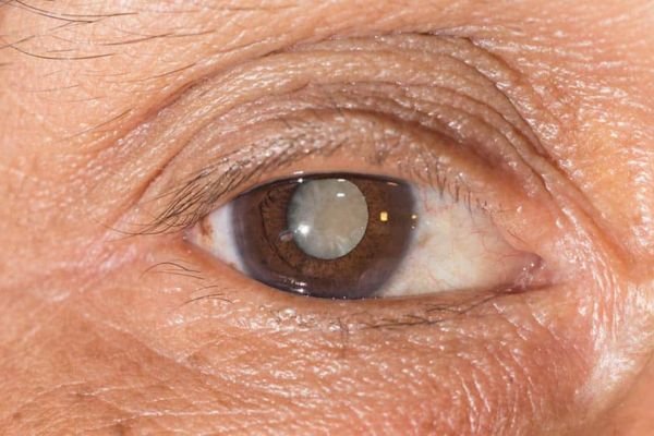 O que é Catarata, Sintomas Iniciais e Por que ela Aparece?